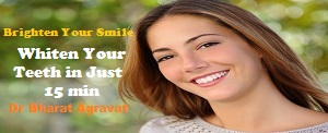 Dr Agravat Dental Clinic best Cosmetic Teeth Whitening Ahmedabad Bodakdev Gujarat India