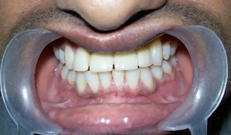 After: fixed teeth on dental implants