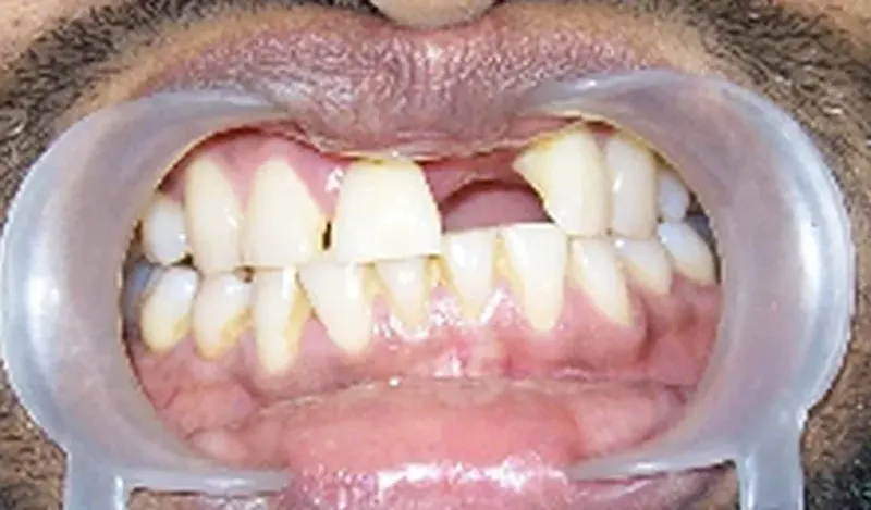 Before treatment