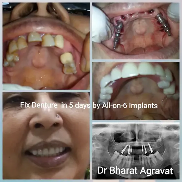 Fixed denture in 5 days with All-on-6 implants
