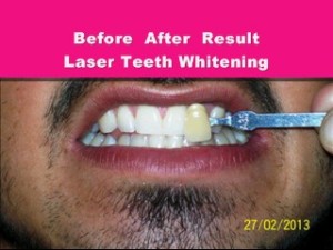 Before After result Laser Teeth Whitening By dentist bharat agravat ahmedabad india