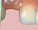single teeth replace by dr bharat agravat