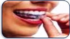 Clear Braces Dr Bharat Agravat dental clinic ahmedabad gujarat india