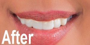 Enhance your Smile and Straighten teeth appearance by One Touch Smile Ahmedabad, gujarat India.