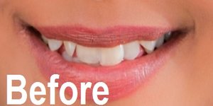 Enhance your Smile and Straighten teeth appearance by One Touch Smile Ahmedabad, gujarat India