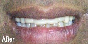 One Touch Smile™ After image replacing tooth ahmedabad, gujarat india