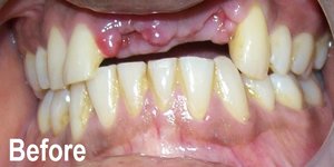 One Touch Smile™ Before image replacing tooth ahmedabad, gujarat india