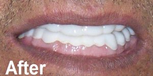 abrasion, wear, erosion, bruxism after treated image by one touch smile ahmedabad, gujarat, india