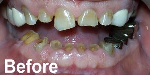 abrasion, wear, erosion, bruxism before treated image by one touch smile ahmedabad, gujarat, india