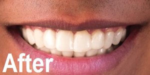 crooked, crowded, malocclusion after treated image by one touch smile ahmedabad, gujarat, india